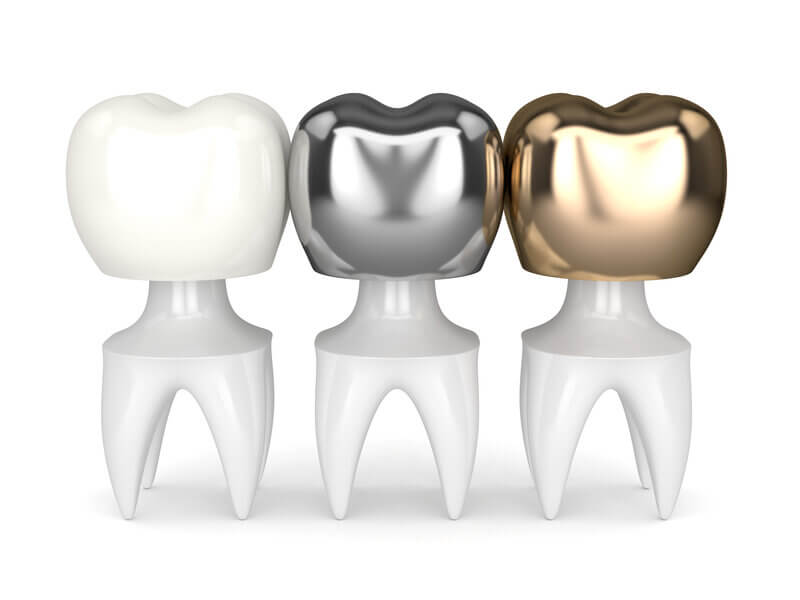 Affordable Dental Crowns In Houston, TX Porcelain Crowns